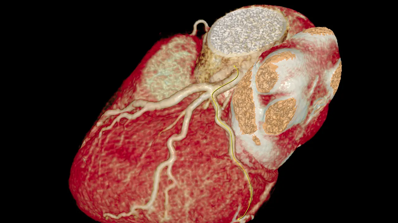 A 3D CT image of the heart showing the coronary arteries