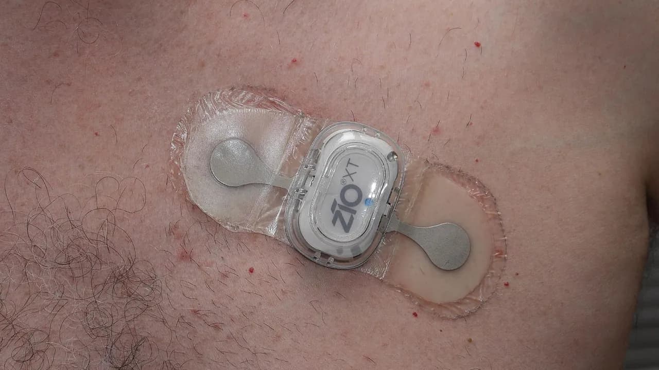 A ZIO ECG patch stuck to the skin of a patient's chest